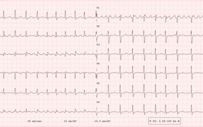 Atrial Flutter vs Atrial Fibrillation